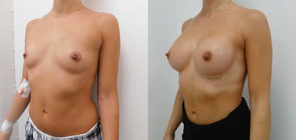 Brystforstørrende operation