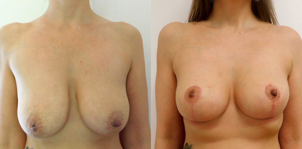 Brystløft før og efter billeder