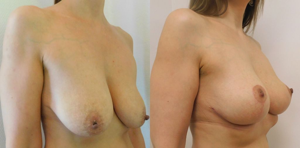 Brystløft uden implantater fra siden
