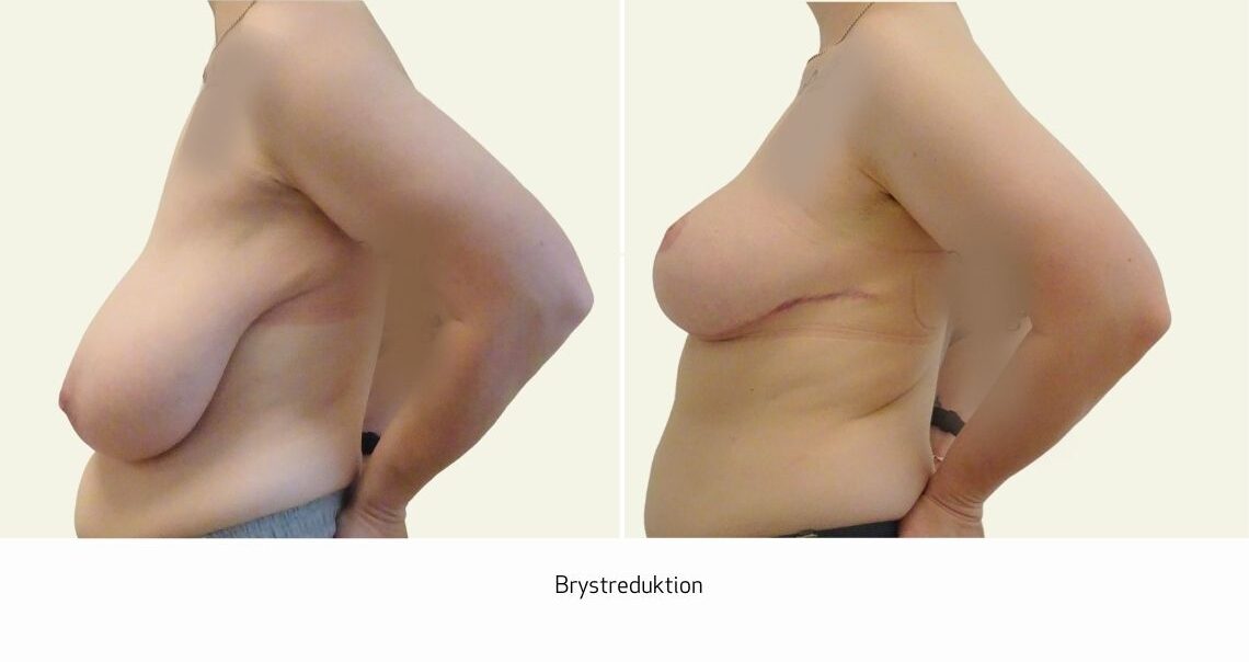 Brystreduktion 1