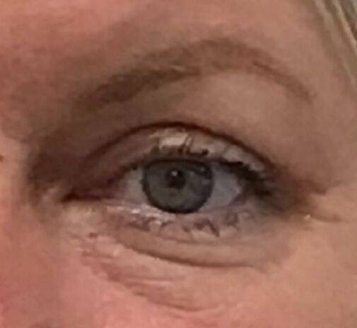 Øvre øjenlåg efter