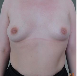 Billedet viser en persons bare overkrop fra skuldrene til maven set forfra. Huden er lys med en let rødme øverst på brystkassen og en svag linje under brysterne, muligvis en tanlinje. Begge bryster er synlige uden tøj eller tilbehør. Der er ingen produkter eller mærkenavne i billedet. Kompositionen er neutral og klinisk i udtrykket.