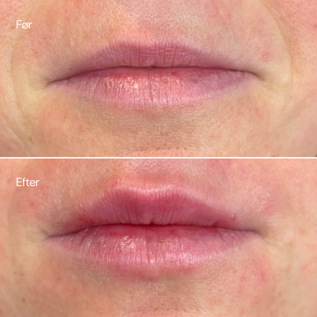 Før- og efter-fotos af en mundparti efter en læbebehandling: øverste billede viser tørre, matte, lysrosa læber med fine linjer, mens nederste viser mere fyldige, glansfulde og rosa læber med tydeligere kontur og færre rynker. Billederne fremhæver forbedret fugtniveau, fylde og definition uden synligt brandnavn eller dekorative produkter. Hudtonen omkring læberne er lys og viser let rødme, og billederne er tæt croppede for at fokusere på resultatet.