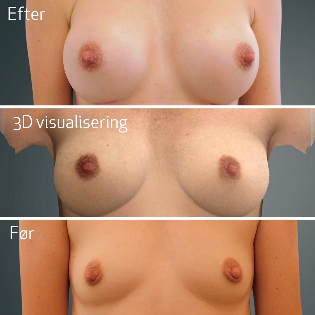 Billedet viser en montage i tre horisontale paneler mærket "Efter", "3D visualisering" og "Før". Det er kliniske før‑og‑efter-billeder af kvindebryster med lys hudtone; 3D-visualiseringen og "Efter" viser større, rundere og mere fyldige bryster end på "Før"-billedet. Nærbillederne fremhæver brystform, placering af brystvorter, subtile ar og en neutral grå baggrund.