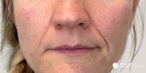 Nærbillede af den nedre del af en kvindes ansigt med fokus på mundområdet, overlæbe, hage og næse. Huden har en naturlig lyserød tone, synlige porer, fine linjer og tydelige nasolabiale folder. Læberne er neutrale i farven og let matte. Et lyst hårstrå ses ved siden af ansigtet. Nederst til højre fremgår logoet "Roskilde Privathospital".