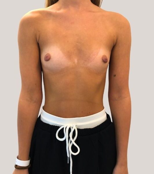 Portræt af en persons overkrop set forfra med bare bryster og solbrun hud samt tydelige tanlinjer. Personen bærer sorte, løstsiddende træningsbukser med bred hvid elastik og hvid snor i livet. Et hvidt armbåndsur sidder på håndleddet, og der ses en lille tatovering på venstre overarm. Ingen synlige mærker eller brandnavne på tøjet.