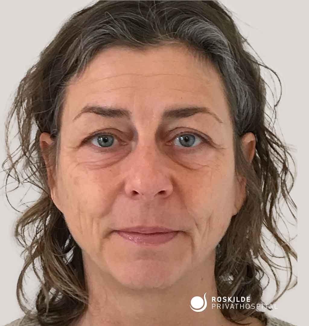 Hudkorrektion af løs hud på øvre- og nedre øjenlåg