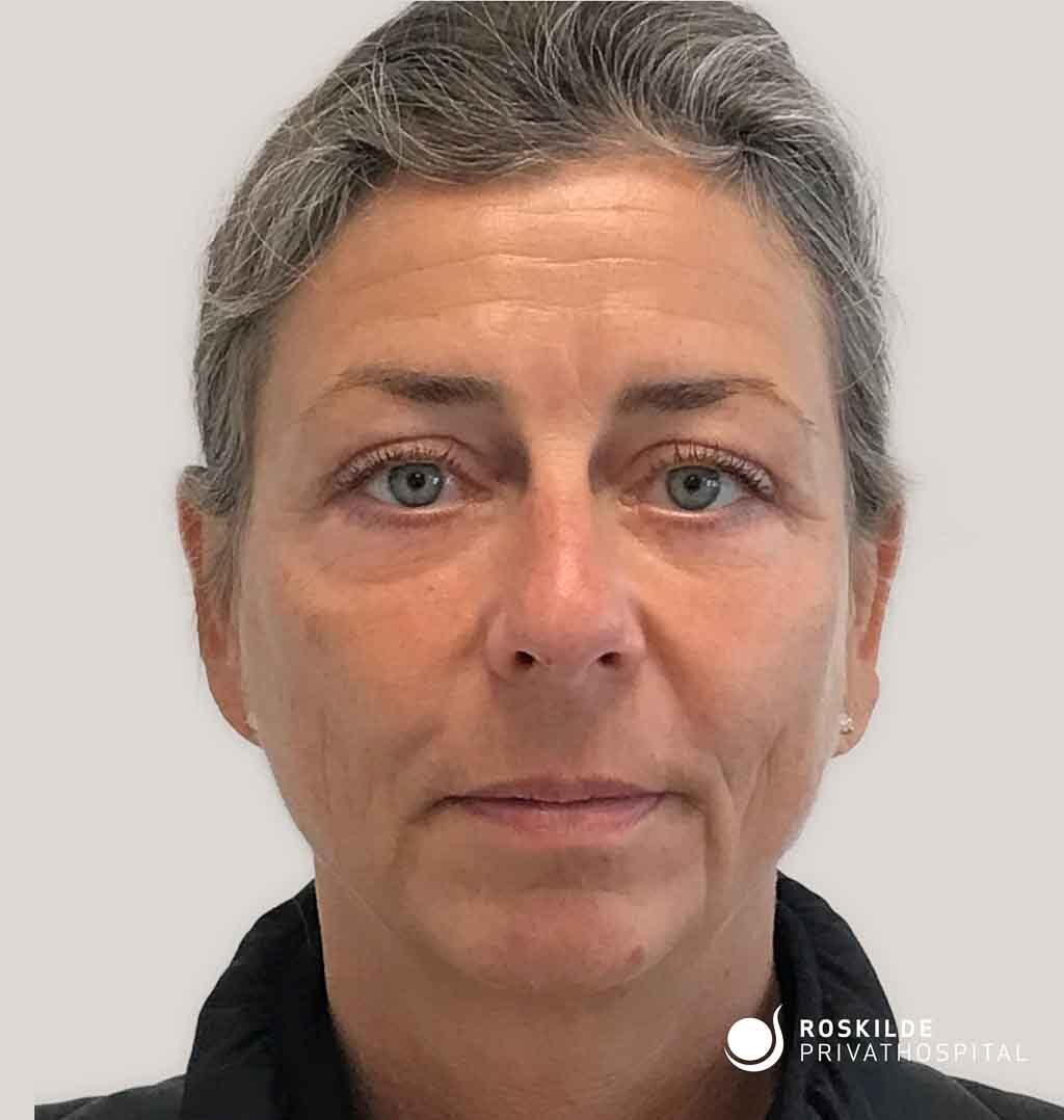 Hudkorrektion af løs hud på øvre- og nedre øjenlåg