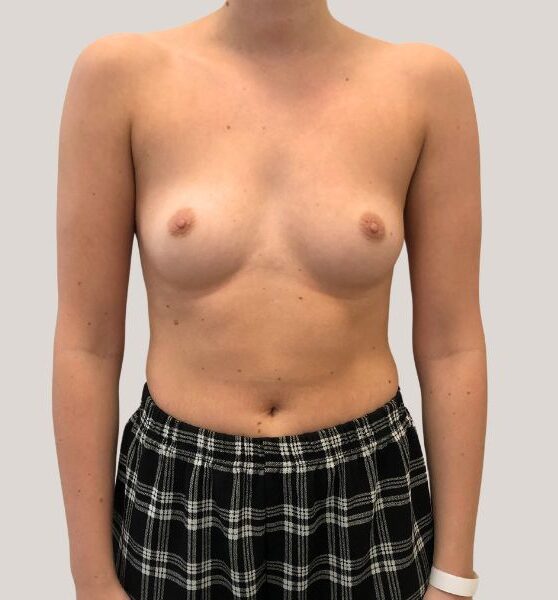 Fotografi af en person fotograferet forfra mod en neutral, lysegrå baggrund. Personen står uden overdel og bærer en sort-hvid ternet nederdel og et hvidt armbånd/ur på venstre håndled. Fokus er på kroppens forside og nederdelens mønster; der er ingen synlige mærker eller brandnavne. Billedet har et klinisk og neutralt udtryk.