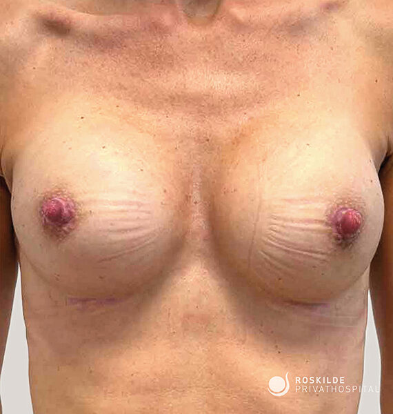 Nærbillede af en torso med synlige brystimplantater efter brystkirurgi. Begge bryster fremstår runde med let rynket implantatoverflade, markerede nipler og ar i brystets underside tæt ved folden. Huden viser naturlig teint og postoperative arheling. Nederst til højre ses hospitalets vandmærke "Roskilde Privathospital". Fotograferingen er taget for medicinsk dokumentation.