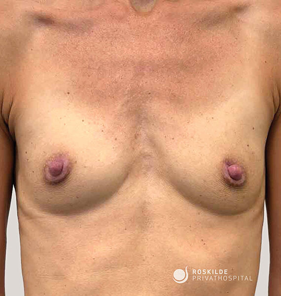 Billedet viser en nærbillede af en persons bare overkrop og brystkasse set forfra. Hudens lysebrune tone, små runde bryster og tydelige brystvorter er synlige mod en neutral baggrund. Billedet har et klinisk, dokumentarisk udtryk, og i nederste højre hjørne ses logo og navn 'Roskilde Privathospital'. Ingen tøj eller andre produkter er til stede i billedet.
