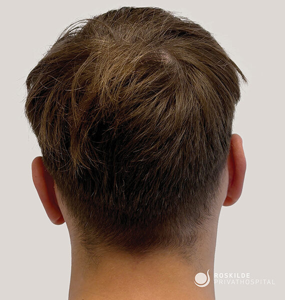 Foto af bagsiden af en persons hoved med kort, brunt hår og synlig hårvækst ved issen. Håret er klippet tæt ved nakken med en blød linje, let tekstur og naturlig glans mod en neutral grå baggrund. Ingen ansigtstræk er synlige. Nederst til højre ses logoet "Roskilde Privathospital", hvilket antyder en klinisk eller medicinsk kontekst.