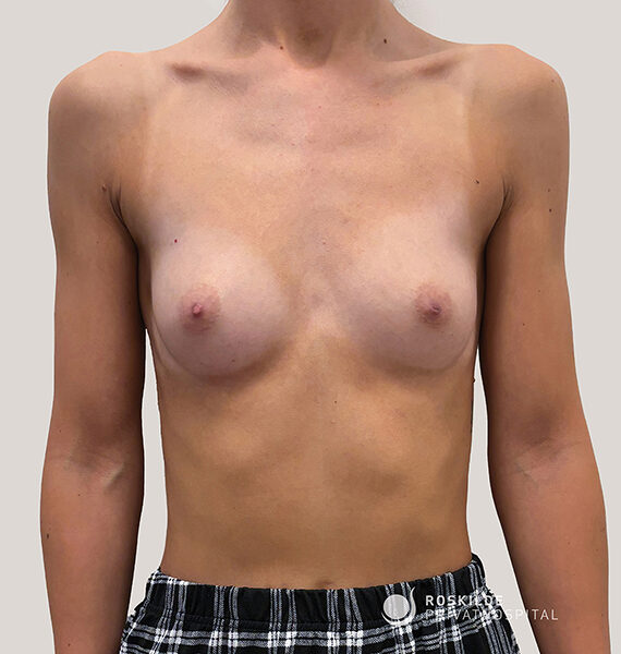 Frontal billede af en overkrop med bare bryster mod en neutral grå baggrund. Nederst ses sorte og hvide ternede bukser. Et lille hvidt logo 'ROSKILDE PRIVATHOSPITAL' er synligt i nederste højre hjørne. Billedet viser brysternes form og symmetri i jævnt, klinisk lys, med neutral hudtone og uden yderligere rekvisitter eller personlige genstande.