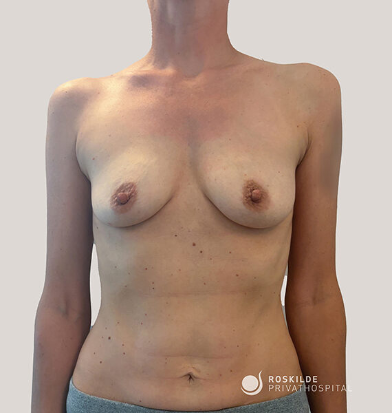 Frontalt klinisk fotografi af en kvindes bare torso og bryster, med naturlig hudtone og små modermærker. Billedet viser brysternes form og brystvorter samt mave og skuldre mod en lys, neutral baggrund. Nederst til højre ses logoet "Roskilde Privathospital". Billedet har et neutralt, medicinsk præg med god belysning og neutral fremstilling.