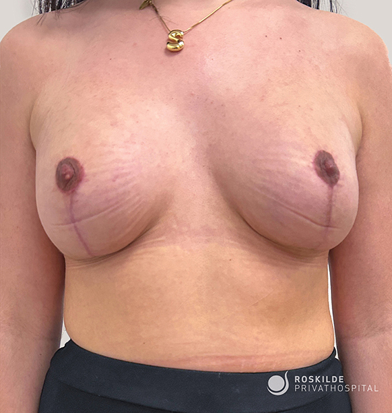Nærbillede af kvindelig overkrop efter brystoperation med synlige ar omkring brystvorter og lodrette ar under dem. En tynd guldkæde med et snoet S-vedhæng hviler på kravebenet. Personen bærer en sort underdel, og nederst til højre ses logoet 'Roskilde Privathospital'. Billedet har klinisk, medicinsk karakter og fokuserer på brysternes form, ar og farveforskelle i huden.