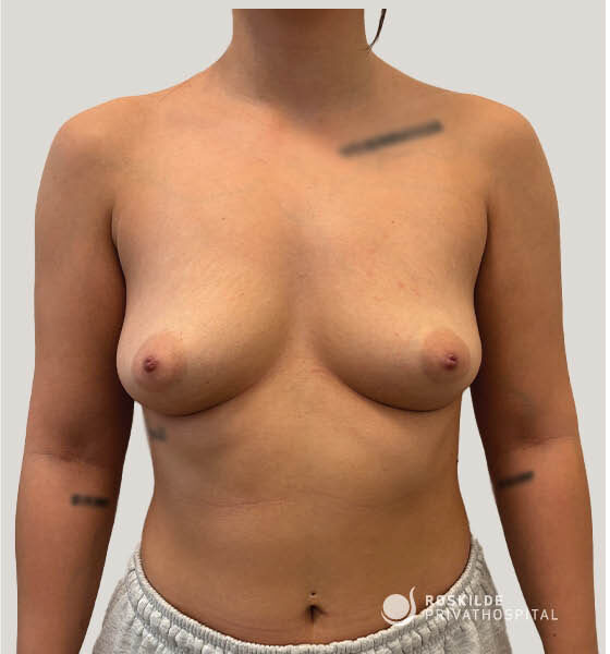 Billedet viser en kvindes bare overkrop fra hals til hofter med begge bryster synlige. Hun bærer lyse joggingbukser, og der ses små tatoveringer eller mærker på skuldre og arme. Baggrunden er neutral grå, og et logo fra Roskilde Privathospital ses i nederste højre hjørne. Fokus ligger på brysternes form, symmetri og kontur.