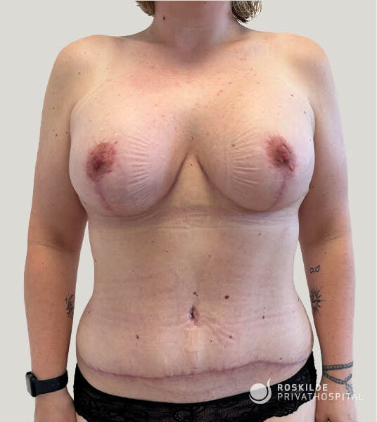 Frontalfoto af en person fra nakke til hofter med bare bryster og synlige ar eller mærker på brystvæv og underliv. Huden viser små prikker og linjer, og personen har tatoveringer på begge underarme samt et sort armbåndsur på venstre arm. Nederst til højre ses logoet "Roskilde Privathospital". Der er ingen kommercielle produkter i billedet.