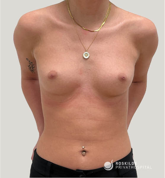 Overkroppen af en person vist foran neutral baggrund, med fokus på smykkerne: to gyldne halskæder hvoraf den ene bærer et rundt vedhæng med solmotiv, samt en navlepiercing med lille sten. Personen har en lille blomster-tatovering på venstre overarm og sorte bukser. Nederst i højre hjørne ses logoet "Roskilde Privathospital". Billedet er klinisk opstillet og neutralt i farver.