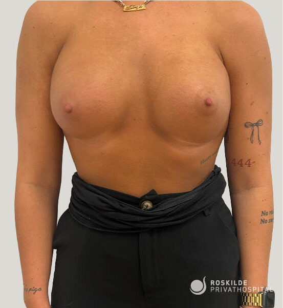 Billedet viser en kvindelig overkrop iført sorte, højttaljede bukser med et omslaget stofbælte og synlig knap. Overkroppen er bar, og personen bærer en guldhalskæde samt et guldarmbånd/ur. Bukserne er matte sorte med et enkelt snit. I nederste højre hjørne ses et hvidt logo og teksten "Roskilde Privathospital", hvilket angiver klinisk kontekst. Farvepaletten domineres af hudtoner, sort og guldfarvet metal.