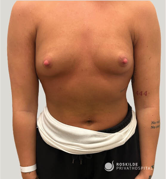 Billedet viser en frontal torso med nøgne bryster på en voksen person iført sorte bukser og en hvid top rullet ned omkring hoften. En hvid hospitalsarmbånd er synligt på håndleddet, og sort undertøj stikker frem over buksekanten. Nederst til højre ses logoet "Roskilde Privathospital". Farverne er neutrale med naturlig hudtone og en ensfarvet, lys baggrund.