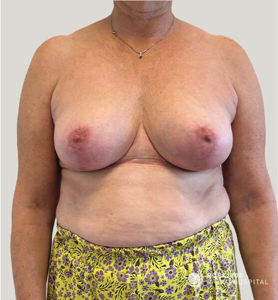 Frontfoto af en person fra hals til hofte, med bar overkrop og synlige bryster, iført en gul nederdel med lilla blomster og en lille sølvhalskæde. Brysterne viser naturlig hudtone, let asymmetri og en arlinje under brystkassen. Baggrunden er neutral og lys. I nederste højre hjørne ses et hvidt hospitalslogo og tekst.