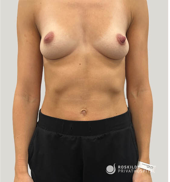 Frontbillede af torso hos patient hos Roskilde Privathospital, viser bryst og mave i stående position efter brystforstørrende operation (BFO). Billedet dokumenterer brysternes form, brystvorter, overkropskontur, armlinjer og neutral baggrund med klinisk, professionel præsentation. Patienten bærer sorte bukser, hospitalsarmbånd og diskret logo.
