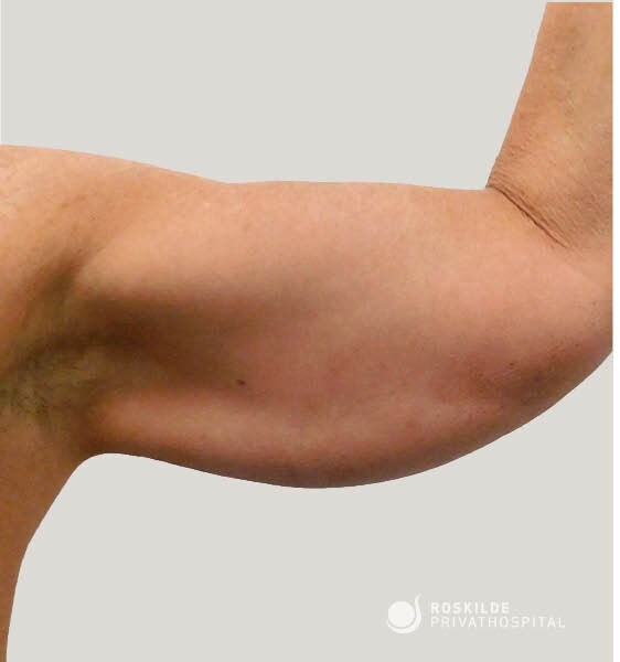 Billede af en bar overarm set i profil med albuen bøjet, synlig løstsiddende hud og blød underarmskontur over tricepsområdet på neutral baggrund. Roskilde Privathospital viser område for armplastik (armløft), med 30 års erfaring i vurdering og behandling af overarmens form og hudoverskud.