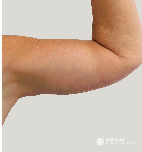 Billedet viser højre overarm i bøjet position, tæt udsnit af hudens overflade med ar og let slapt væv, dokumentation før/efter overarmsplastik. Roskilde Privathospital, erfaren klinik, viser resultat efter armløft (overarmsplastik) på professionel og neutral baggrund. Med over 30 års erfaring dokumenterer vi heling.