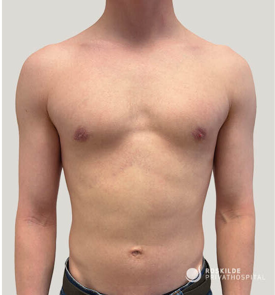 Frontal klinisk foto af en mands overkrop med fokus på brystet og abdomen, dokumentation for gynekomasti-operation. Billedet viser brystvorter, brystform og hudtoner i neutral, diskret position med arme nedad. Roskilde Privathospital leverer professionel, erfaren dokumentation til kirurgisk planlægning og opfølgningsvurdering.