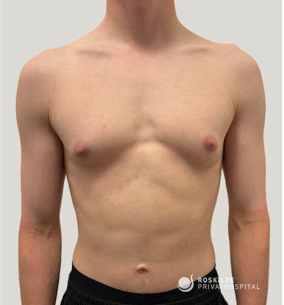 Roskilde Privathospital, med 30 års erfaring: frontalt fotografi af en ung mands brystparti, brugt til planlægning af gynækomastioperation (brystreduktionsoperation). Billedet viser brysternes kontur, asymmetri, brystvorter og thorax, dokumenteret i en professionel, tryg kirurgisk vurderingskontekst til patientkonsultation.