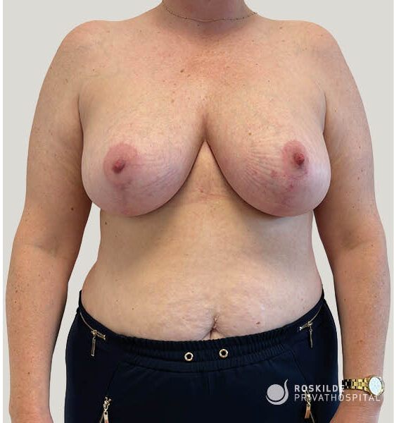 Frontbillede af patientens torso med fokus på brysterne, inkl. areola og brystvæv, til vurdering af brystløft (mastopeksi). Roskilde Privathospital, med 30 års erfaring, præsenterer et neutralt klinisk billede i stående position til faglig kirurgisk vurdering, individuel behandlingsplanlægning og dokumentation.