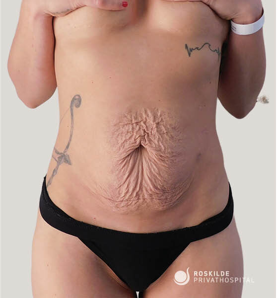 Foto fra Roskilde Privathospital viser en kvindes bare mave med udtalt løs hud, dybe folder og strækmærker centralt over underlivet. Sort undertøj, tatoveringer ved siderne og hospitalarmbånd er synlige. Billedet illustrerer et tilfælde egnet til maveplastik (abdominoplastik). Klinikkens 30 års erfaring underbygger professionel vurdering.