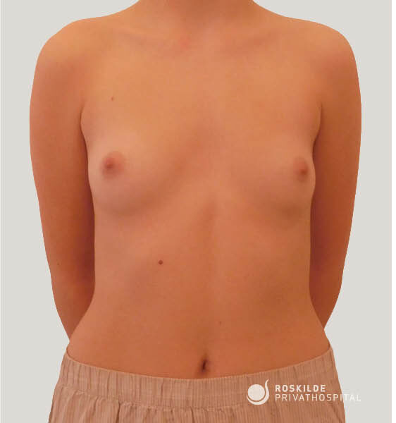 Frontal billede af en kvindelig overkrop uden ansigt, med små bryster og naturlig hudtone. Foto fra Roskilde Privathospital illustrerer kandidat til brystforstørrende operation (BFO) og viser brysternes form og symmetri med klinisk, professionel dokumentation fra en privatklinik med 30 års erfaring.