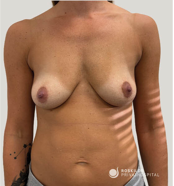 Fotografi af kvindelig overkrop hos Roskilde Privathospital, viser bryst og mave forud for brystløft (bryst) behandling. Neutral baggrund, frontal synsvinkel med naturlig hudtone og brystptose tydelig. Professionel, klinisk præsentation fra en privatklinik med 30 års erfaring. Dokumentationsfoto til konsultation og behandlingsplanlægning.