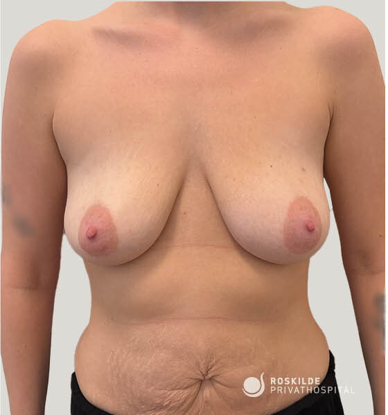 Fotografi af forreste torso, viser hængende bryster og løs mavehud. Klinisk før-billede fra Roskilde Privathospital med fokus på brystløft (mastopexi) og maveplastik, tydeliggør brystform, brystvorter og abdominal hudoverskud. Synlig navle, strækmærker og let asymmetri mellem brysterne.