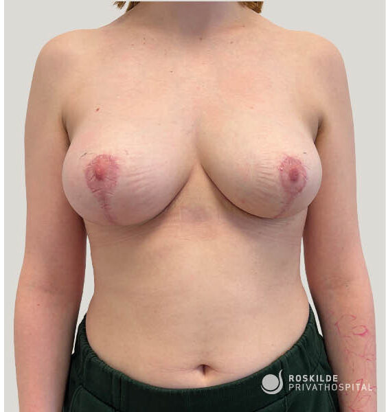 Frontal billede af kvindelig torso efter brystløft, synlige ar omkring brystvorter og vertikale arr der viser brysternes form, symmetri og heling. Neutral hvid baggrund og klar belysning. Roskilde Privathospital, bryst, brystløft udført af erfarent team med 30 års erfaring i plastikkirurgi.