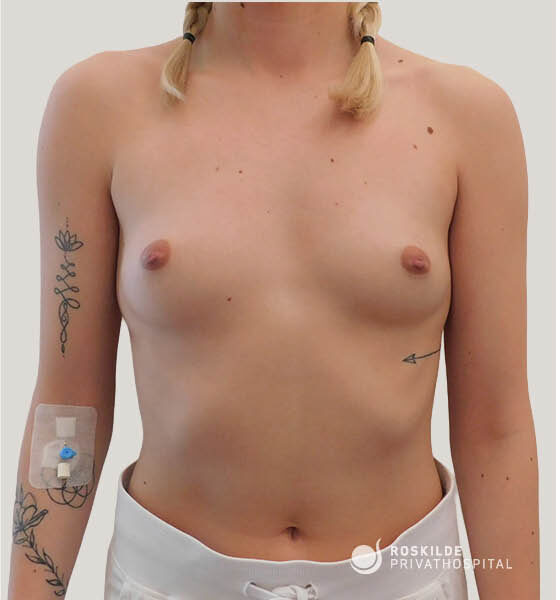 Frontal klinisk billede af patientens torso hos Roskilde Privathospital til dokumentation af brystforstørrende operation (BFO). Foto viser brystparti med brystvorter, mave, arme med tatoveringer og venflon, neutral baggrund fra en klinik med 30 års erfaring, professionel præoperativ fremstilling af brystområdet.