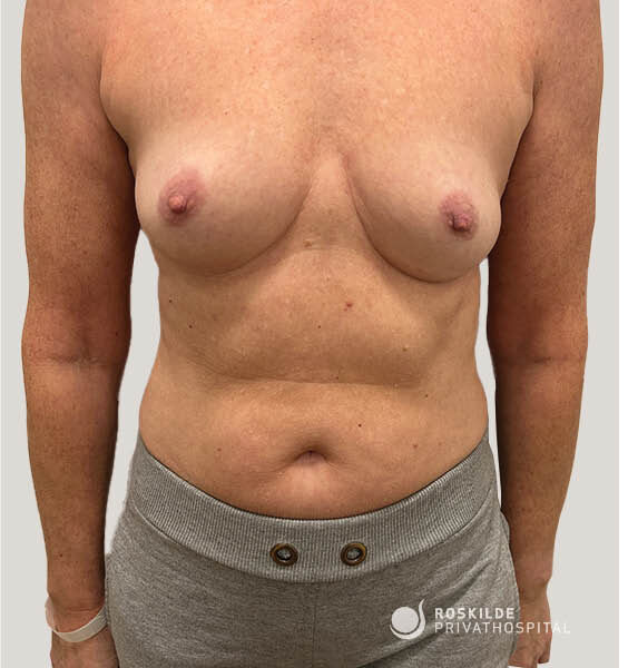 Frontfoto af kvindelig torso med synlige bryster og mave. Klinisk dokumentation af brystforstørrende operation (BFO) udført på Roskilde Privathospital med 30 års erfaring. Billedet viser brystets form, symmetri, arstatus, hudtekstur, naturlige proportioner og veldefineret kontur til konsultation og vejledning.