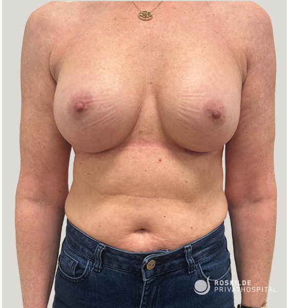 Frontal foto af kvindelig overkrop fra hals til hofter efter brystforstørrende operation (BFO). Billedet viser begge bryster med synlig form og areola, huden på øvre mave, jeanslinje og en halskæde. Roskilde Privathospital nederst til højre; professionel dokumentation fra klinik med 30 års erfaring.