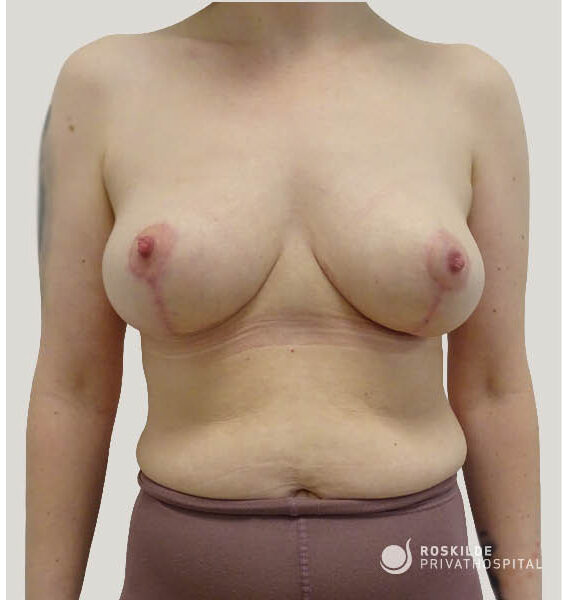 Forfra billede af kvindelig torso efter brystløft: Roskilde Privathospital viser faste løftede bryster med synlige periareolære og vertikale ar. Scenen omfatter bryst, øvre mave og talje, neutral baggrund; klinisk, oplysende præ- eller postoperativ dokumentation fra en privatklinik med 30 års erfaring.