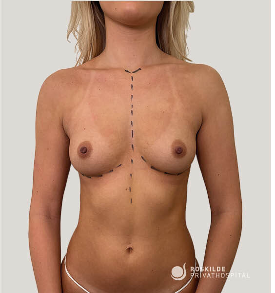 Frontalbillede af kvindelig torso med kirurgiske markeringer på brystvæv og sternum, forud for brystforstørrende operation (BFO). Billedet viser bryster, brystvorter og midtlinje. Roskilde Privathospital, med 30 års erfaring, stående frontalvisning på neutral baggrund med tydelige præoperative streger, prikker og målretning.