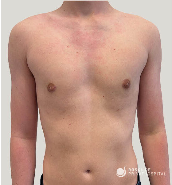 Frontalbillede af en ung mands overkrop uden tøj, med synlige brystkirtler og let asymmetri mod neutral grå baggrund. Roskilde Privathospital, med 30 års erfaring, anvender billedet til dokumentation af gynekomastioperation (brystkorrektion). Klinisk, professionel fremstilling af brystområdet fra hals til navle, logo nederst.