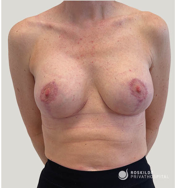 Frontalbillede af bryst og øvre mave efter brystforstørrende operation (BFO) med løft; synlige ar omkring areola og naturlig kontur. Billedet viser patientens brystområde i klinisk setting. Roskilde Privathospital, erfaren specialist med 30 års praksis. Neutral baggrund, patient står forfra med arme bag ryggen; fotografering til dokumentation af resultat.