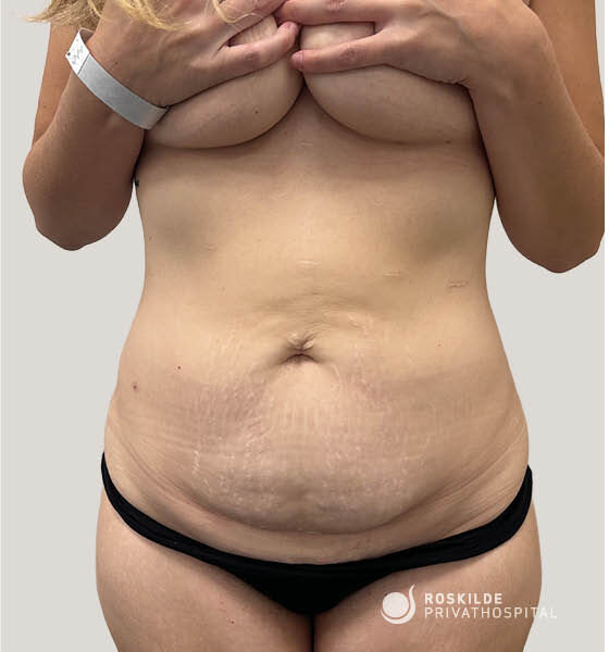 Frontfoto af en kvindes overkrop hos Roskilde Privathospital med hænder, der dækker brystet, synlig abdomen med løs hud, bukfolder og strækmærker, sort trusse og hospitalsarmbånd på neutral baggrund. Præoperativ billede til vurdering før maveplastik af maveområdet i klinisk, erfaren kontekst (30 års erfaring).