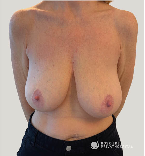 Billede af forfra visning af overkrop fra hals til hofter med bare bryster, let brystasymmetri og synlige ar/areolaer; patienten står med hænder bag ryggen. Foto fra Roskilde Privathospital, der illustrerer brystløft (mastopeksi) af brystet i klinisk dokumentation hos en klinik med 30 års erfaring.