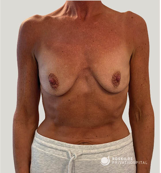 Frontalfoto af kvindelig torso fra hals til hofter med let hængende bryster og synlige brystvorter. Billedet bruges af Roskilde Privathospital til vurdering af brystløft (bryst) og illustrerer præoperativt bryststadie, hudkvalitet og brystform hos specialister med 30 års erfaring i klinisk konsultation.