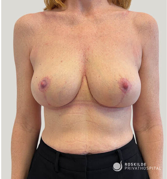 Frontalbillede af torso hos voksen kvinde efter brystforstørrende operation (BFO), med symmetriske, velplacerede bryster, synlige periareolære og inframammære ar samt naturlig hudtekstur. Billedet viser brystregionen og øvre mave mod neutral baggrund. Roskilde Privathospital – klinisk og professionel dokumentation fra 30 års erfaring.