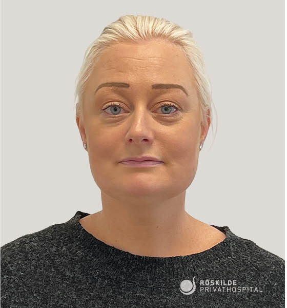 Portrætfoto af en kvinde set forfra med neutralt udtryk, lyst opsat hår og synlig kæbe- og halslinje, uden smil, med let makeup og neutral lys baggrund. Billedet fra Roskilde Privathospital illustrerer ansigtsløft (ansigt), præsenteret i professionel klinisk kontekst fra en privat hospital med 30 års erfaring.