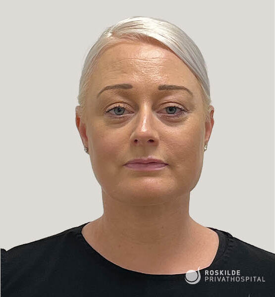 Portrætfoto af voksen kvinde med lyst opsat hår, diskrete øreringe og let make-up, set forfra mod neutral grå baggrund. Billedet fokuserer på ansigtets kæbelinje og hals i forbindelse med ansigtsløft ved Roskilde Privathospital, professionel før-/efter-dokumentation fra klinik med 30 års erfaring.